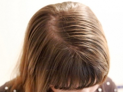 ¿Como utilizar la sal contra la caspa y para frenar la caída del cabello?